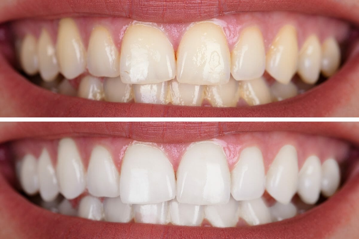teeth_whitening-1200x800.jpg