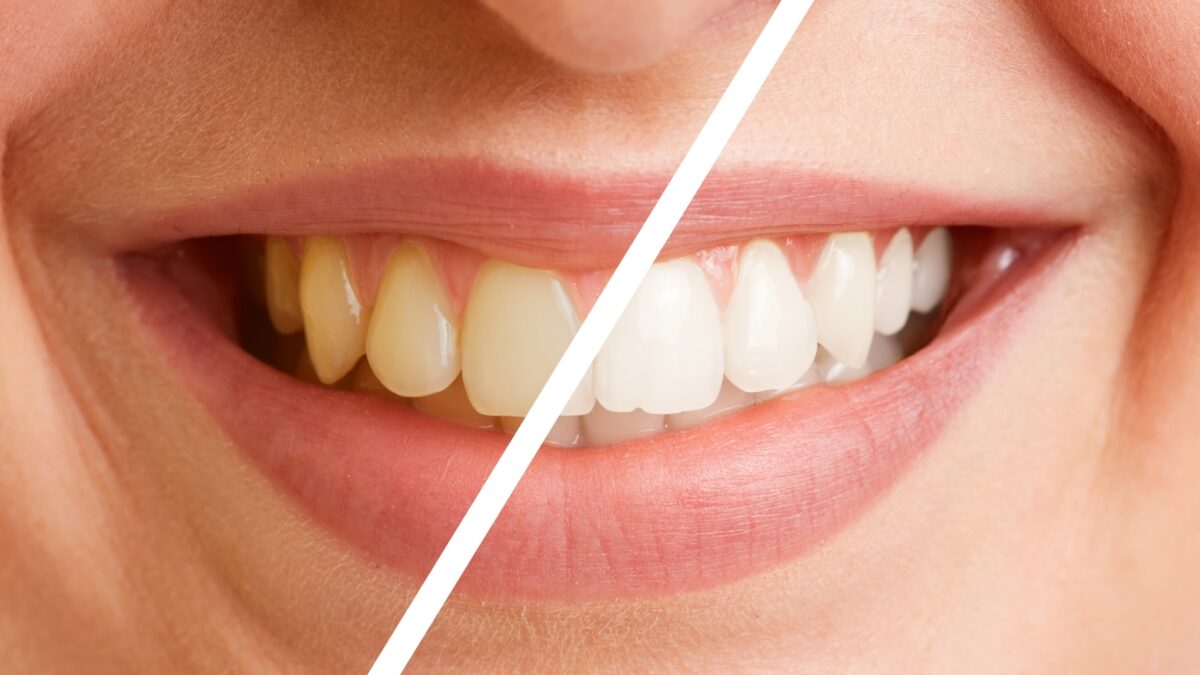 Unlock-a-Dazzling-Smile_-Truths-and-Myths-About-Teeth-Whitening-1200x675.jpg