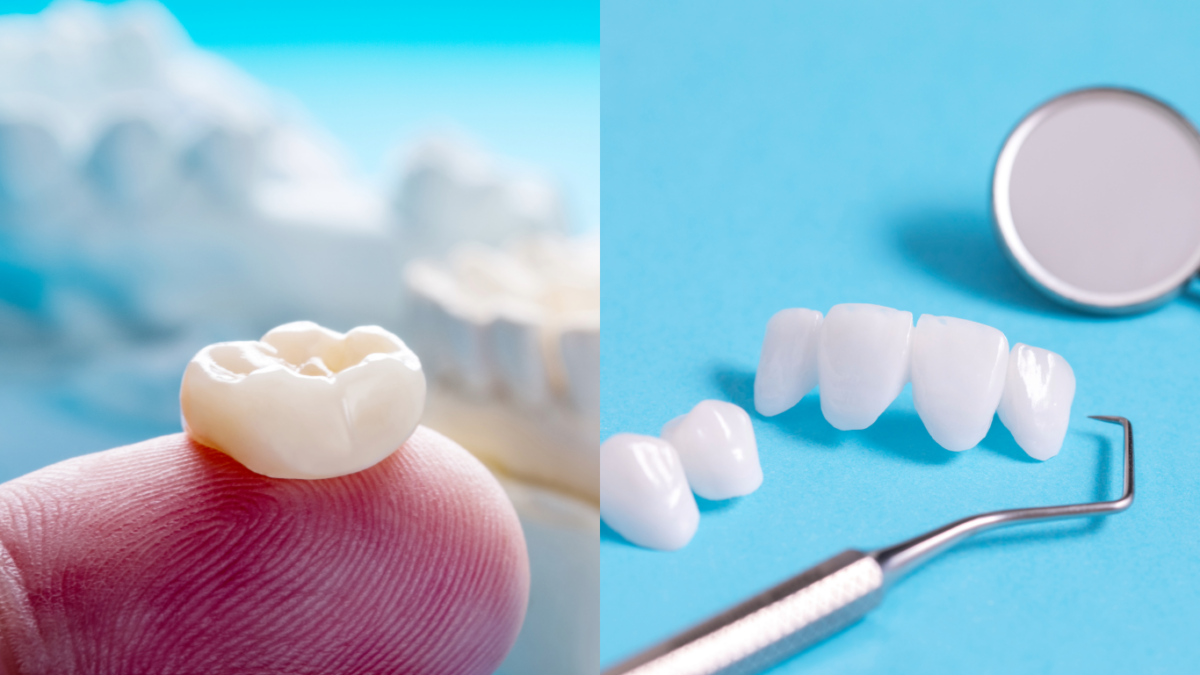 Dental-Veneers-vs-Crowns-in-2024-1200x675.png
