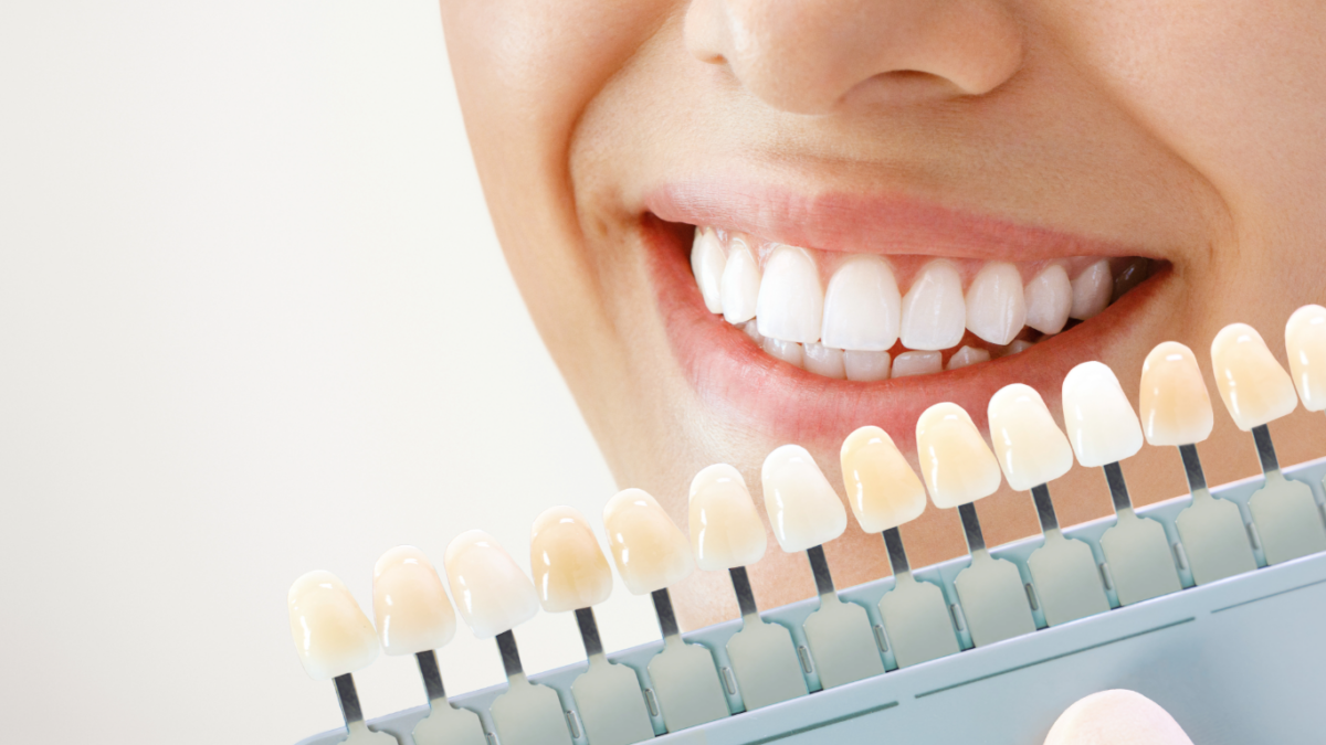 Professional-Teeth-Whitening-Techniques-What-Works-1200x675.png